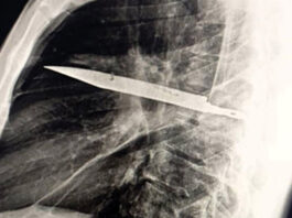 В Танзании мужчина прожил 8 лет с ножом в груди и не догадывался об этом