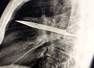 В Танзании мужчина прожил 8 лет с ножом в груди и не догадывался об этом