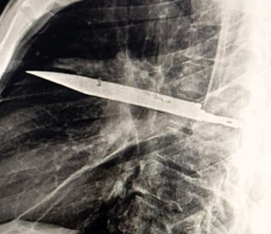 В Танзании мужчина прожил 8 лет с ножом в груди и не догадывался об этом