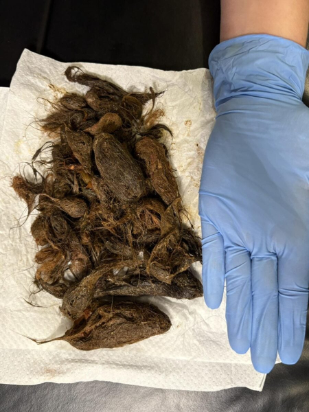 В Луцке из желудка 7-летней девочки извлекли почти 700 граммов волос | ФОТО